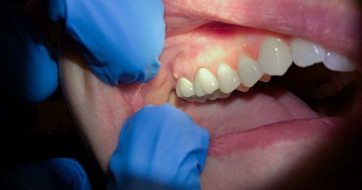 טיפול שורש כדרך לרפא מורסה בשן