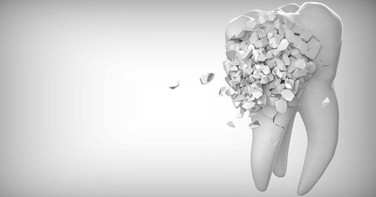 סדקים בשיניים וטיפול שורש – מה הקשר בין השניים?